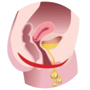 Inkontinencia kezelés előtti állapot gyenge gátizomzat