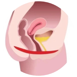 Inkontinencia kezelés utáni állapot megerősített gátizomzat